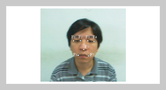 Real-Time Patients’ Face Tracking Based on Facial Feature Matching