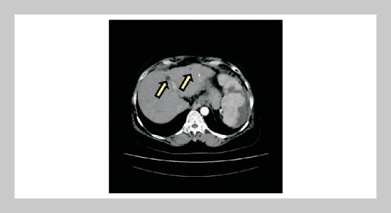 Rough Classifier Based on Region Growth Algorithm for Identifying Liver CT Image